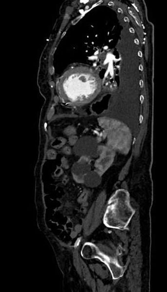 File:Abdominal aortic aneurysm with thrombus fissuration (Radiopaedia 73192-83919 Sagittal C+ arterial phase 36).jpg