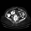 Abdominal wall recurrence after colorectal resection for cancer (Radiopaedia 23444-23523 Axial C+ portal venous phase 22).jpg