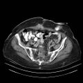 Abdominal wall recurrence after colorectal resection for cancer (Radiopaedia 23444-23523 Axial C+ portal venous phase 29).jpg