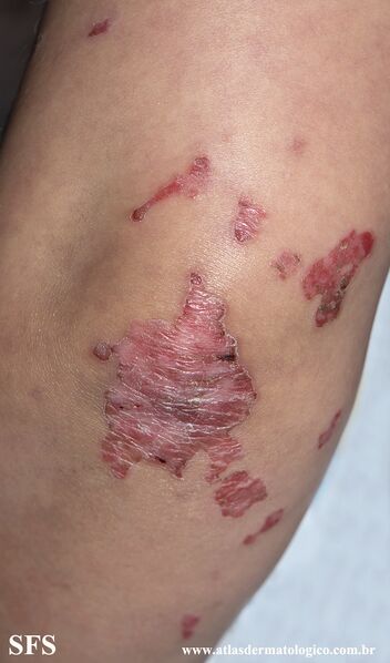File:Acrodermatitis Enteropathica (Dermatology Atlas 44).jpg