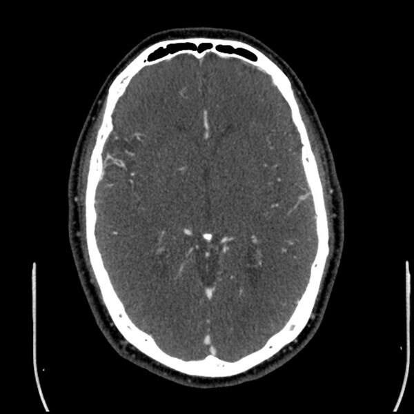 File:Acute A3 occlusion with ACA ischemic penumbra (CT perfusion) (Radiopaedia 72036-82527 Axial C+ arterial phase thins 77).jpg