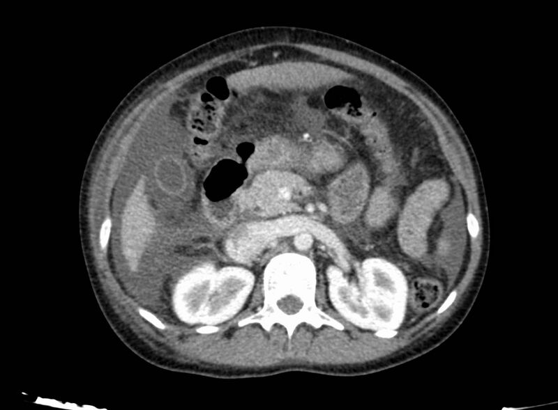 File:Acute Budd-Chiari syndrome (Radiopaedia 60858-68638 Axial C+ portal venous phase 117).jpg