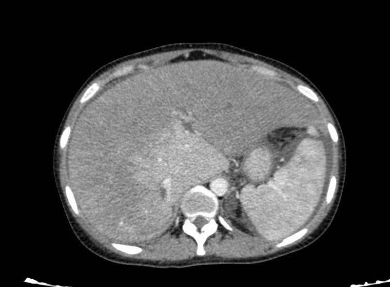 File:Acute Budd-Chiari syndrome (Radiopaedia 60858-68638 Axial C+ portal venous phase 68).jpg