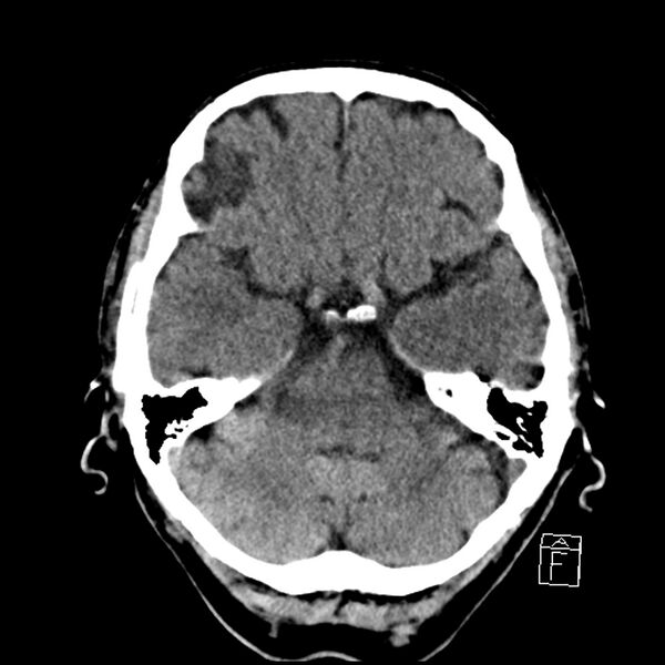 File:Acute P1 occlusion with PCA ischemia penumbra (CT perfusion) (Radiopaedia 72084-82586 Axial non-contrast 11).jpg
