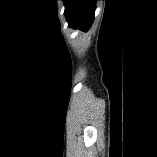 File:Acute appendicitis (Radiopaedia 27049-27227 Sagittal C+ portal venous phase 1).jpg