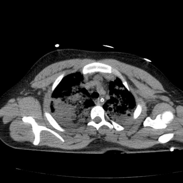 File:Acute aspiration pneumonitis (Radiopaedia 33605-34703 Axial non-contrast 28).jpg
