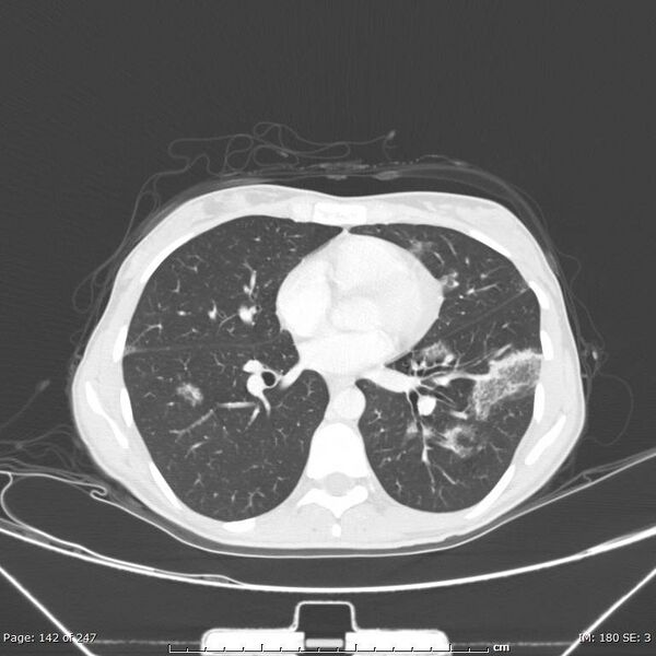 File:Acute eosinophilic pneumonia (Radiopaedia 48211-53073 Axial lung window 51).jpg