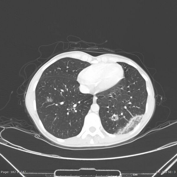 File:Acute eosinophilic pneumonia (Radiopaedia 48211-53073 Axial lung window 65).jpg