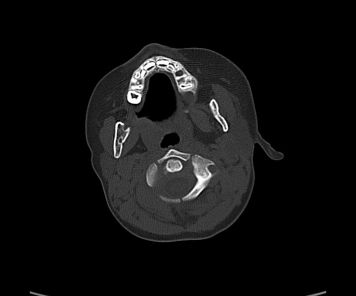 File:Acute hemorrhagic contusion (Radiopaedia 63660-72336 Axial bone window 5).jpg