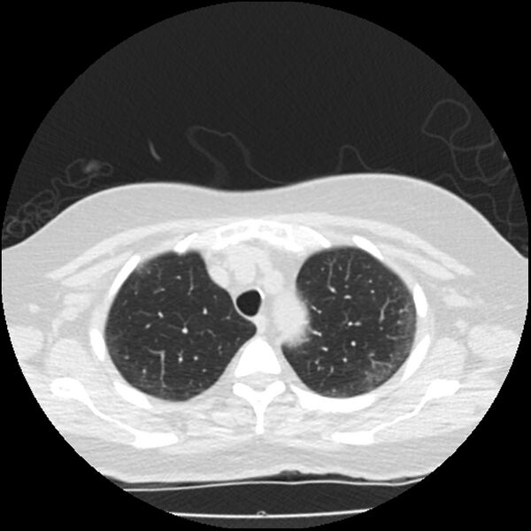 File:Acute interstitial pneumonitis (Radiopaedia 45404-49444 Axial lung window 22).jpg