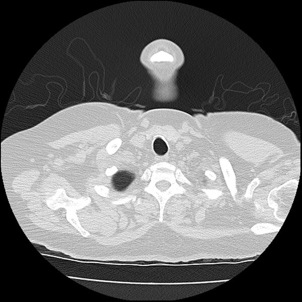File:Acute interstitial pneumonitis (Radiopaedia 45404-49452 Axial lung window 3).jpg