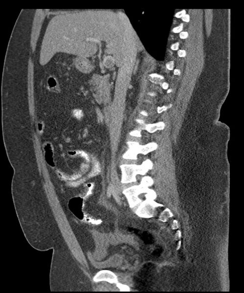 File:Acute mesenteric venous ischemia (Radiopaedia 46041-50383 Sagittal C+ portal venous phase 51).jpg