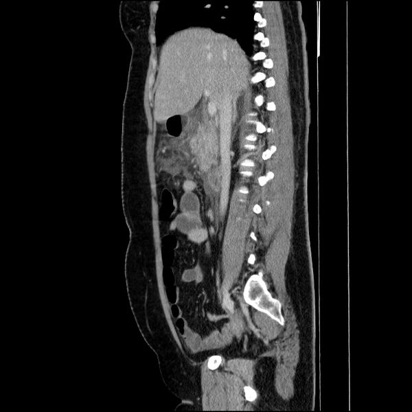 File:Acute pancreatitis (Radiopaedia 69236-79012 Sagittal C+ portal venous phase 61).jpg