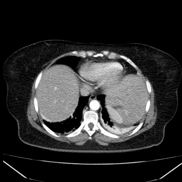 File:Acute pancreatitis - Balthazar C (Radiopaedia 26569-26714 Axial C+ arterial phase 9).jpg