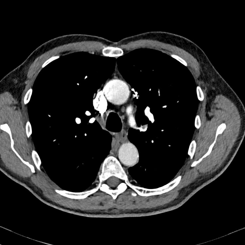 Acute pulmonary embolism (Radiopaedia 81677-95570 Axial C+ CTPA 29).jpg