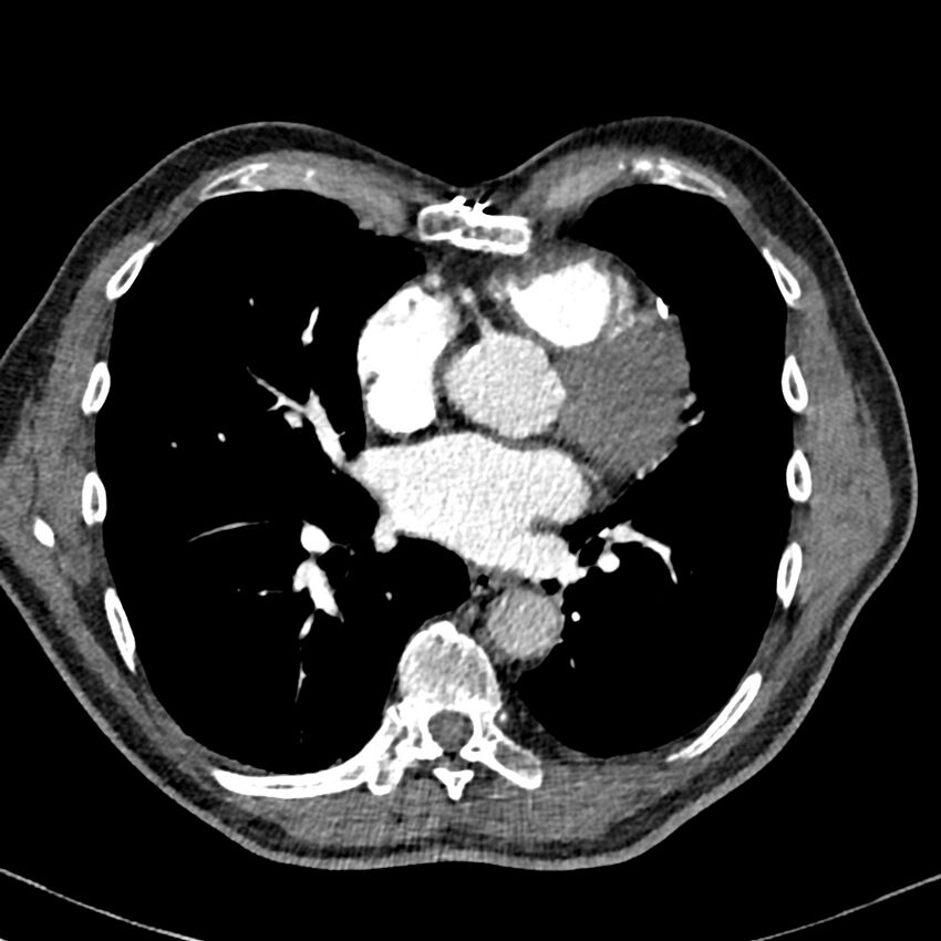 Acute pulmonary embolism (Radiopaedia 81677-95570 Axial C+ CTPA 71).jpg