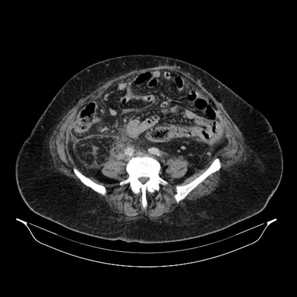 File:Acute pyelonephritis (Radiopaedia 25657-25837 Axial renal parenchymal phase 53).jpg