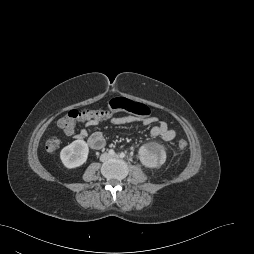 Acute pyelonephritis with renal vein thrombosis (Radiopaedia 58020-65053 Axial renal parenchymal phase 119).jpg