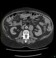 Acute renal failure post IV contrast injection- CT findings (Radiopaedia 47815-52557 Axial non-contrast 38).jpg