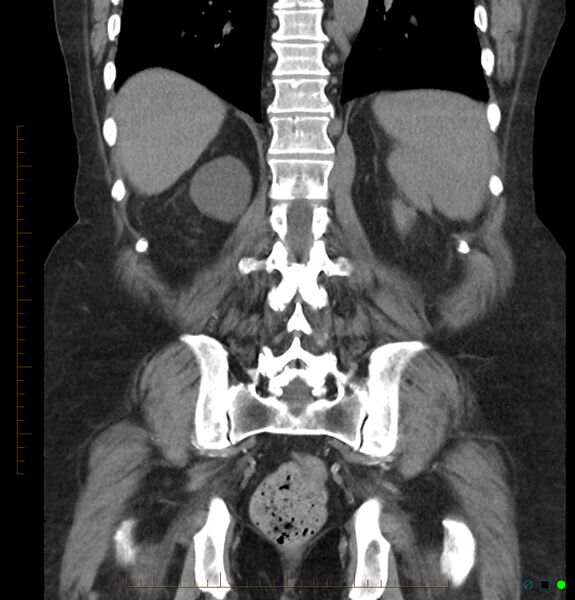 File:Acute renal failure post IV contrast injection- CT findings (Radiopaedia 47815-52557 Coronal non-contrast 37).jpg