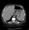 Acute renal failure post IV contrast injection- CT findings (Radiopaedia 47815-52559 Axial C+ portal venous phase 16).jpg