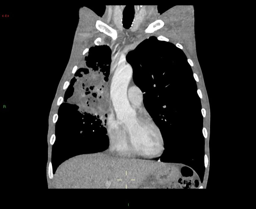 Acute right lung abscess (Radiopaedia 34806-36258 Coronal C+ arterial phase 37).jpg