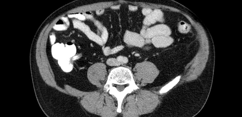 Acute sigmoid colon diverticulitis (Radiopaedia 55507-61976 Axial C+ portal venous phase 45).jpg