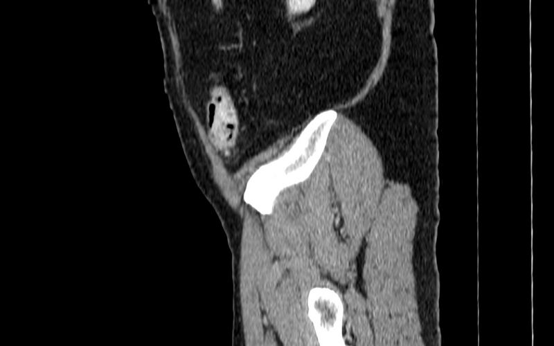 File:Acute sigmoid colon diverticulitis (Radiopaedia 55507-61976 Sagittal C+ portal venous phase 126).jpg