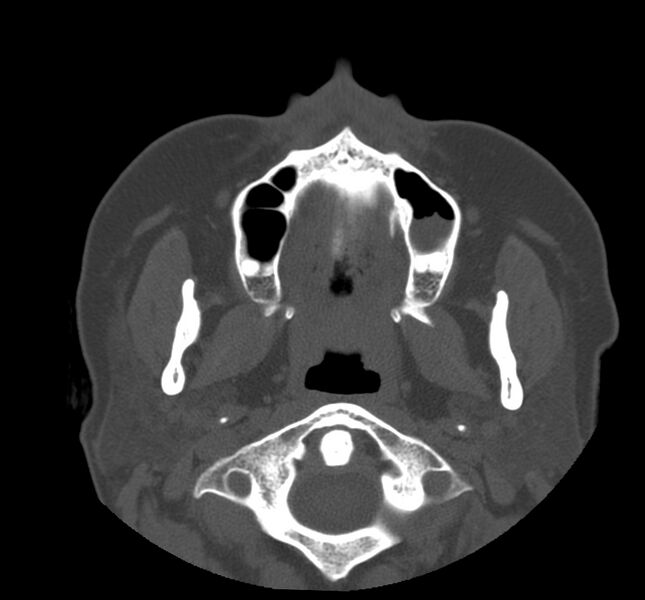 File:Acute sinusitis (Radiopaedia 22419-22455 Axial non-contrast 4).jpg