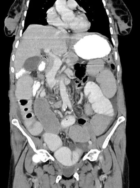 File:Acute small bowel (ileal) volvulus (Radiopaedia 71740-82139 Coronal C+ portal venous phase 49).jpg