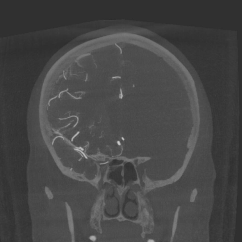 Acute subarachnoid hemorrhage and accessory anterior cerebral artery (Radiopaedia 69231-79010 Coronal arterial - MIP 36).jpg