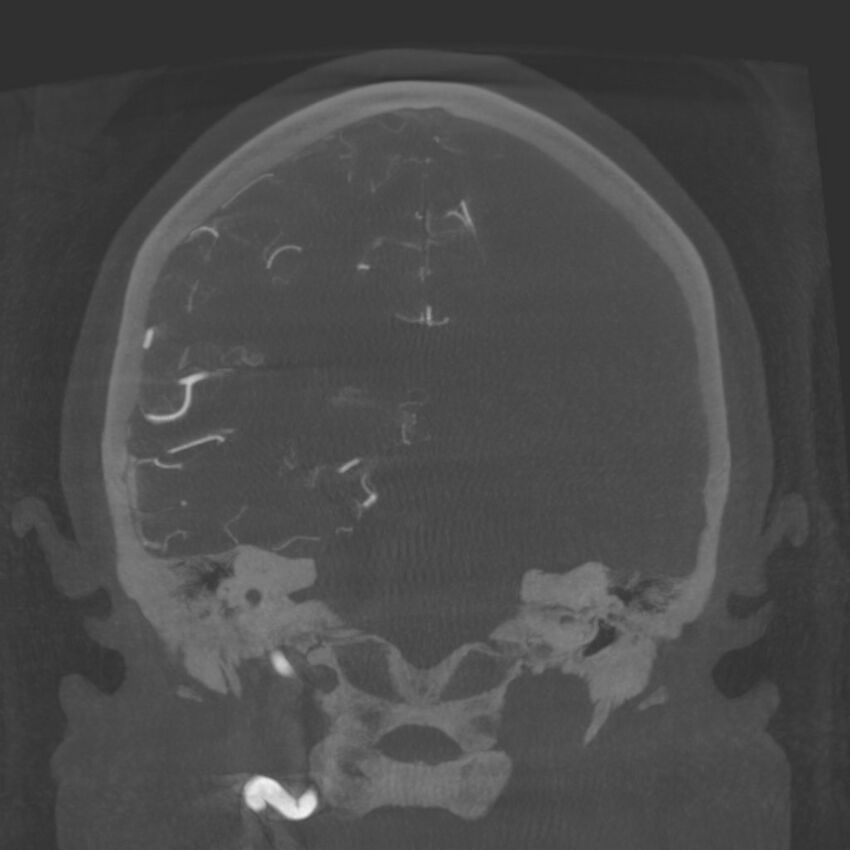 Acute subarachnoid hemorrhage and accessory anterior cerebral artery (Radiopaedia 69231-79010 Coronal arterial - MIP 63).jpg