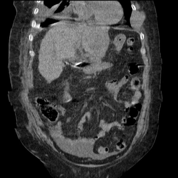 File:Acute tubular necrosis (Radiopaedia 28077-28334 G 32).jpg