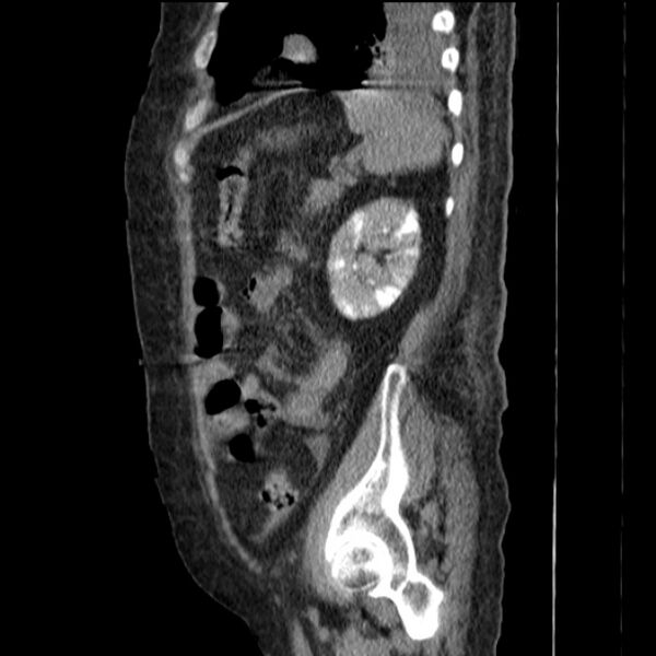 File:Acute tubular necrosis (Radiopaedia 28077-28334 H 66).jpg