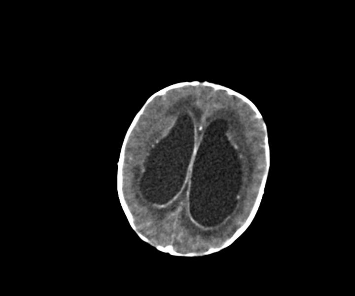 File:Acute ventriculitis (Radiopaedia 57502-64459 Axial +contrast 12).jpg