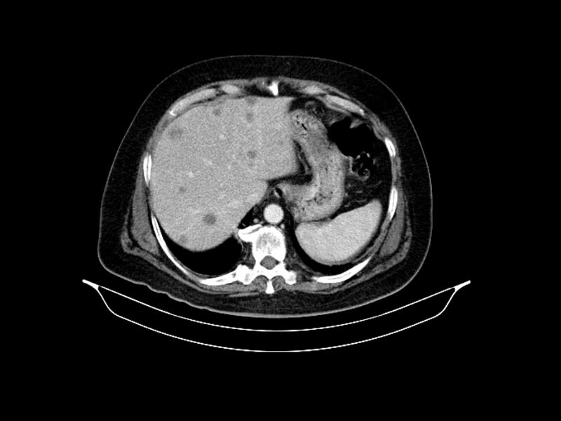File:Adenocarcinoma of pancreas with hepatic metastasis (Radiopaedia 64332-73122 Axial C+ portal venous phase 22).jpg