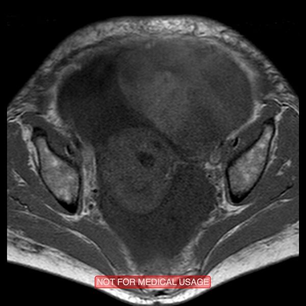 File:Adenocarcinoma of the cervix (Radiopaedia 28373-28615 Axial T1 14).jpg