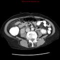 Adenocarcinoma of the colon (Radiopaedia 8191-9039 Axial liver window 42).jpg