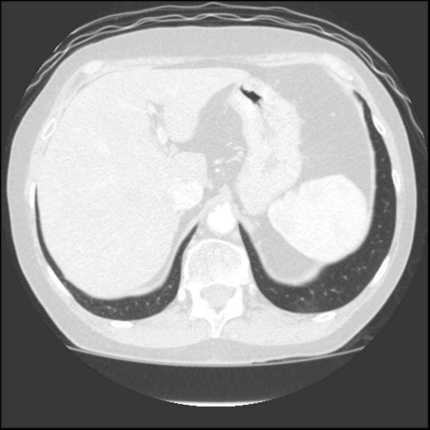 Adenocarcinoma of the lung (Radiopaedia 41015-43755 Axial lung window 114).jpg