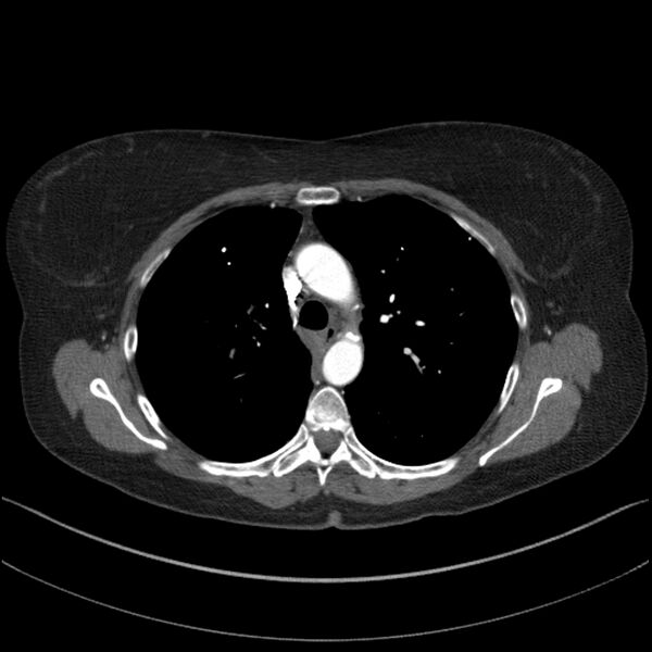 File:Adenocarcinoma of the lung (Radiopaedia 44205-47803 Axial C+ portal venous phase 29).jpg