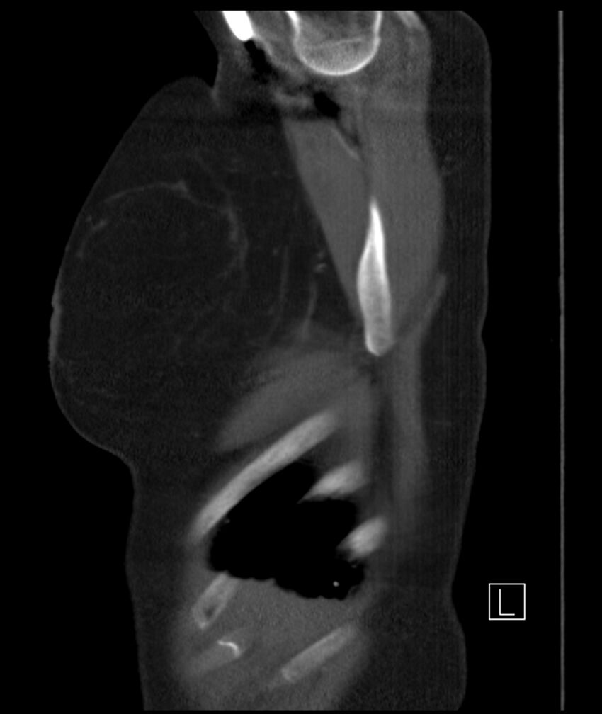Adenocarcinoma of the lung (Radiopaedia 44205-47803 Sagittal C+ portal venous phase 54).jpg