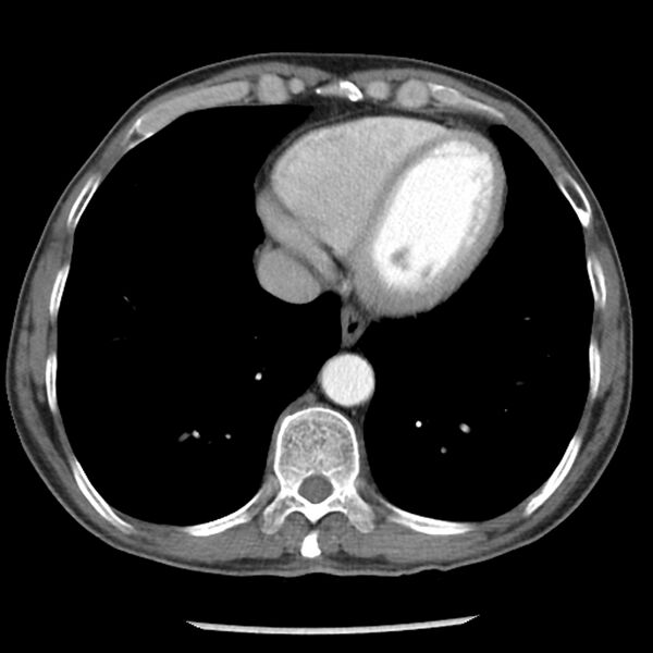 File:Adenocarcinoma of the lung - micropapillary predominant (Radiopaedia 42446-45563 Axial C+ portal venous phase 56).jpg