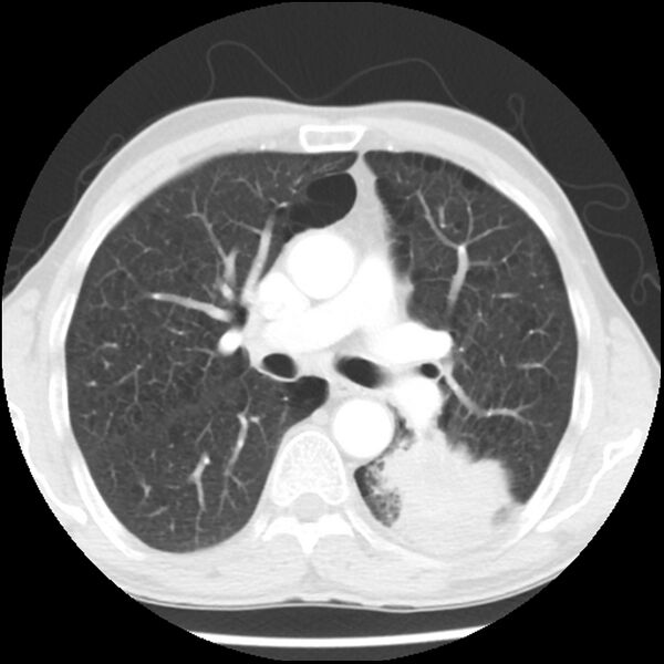 File:Adenocarcinoma of the lung - micropapillary predominant (Radiopaedia 42446-45563 Axial lung window 32).jpg