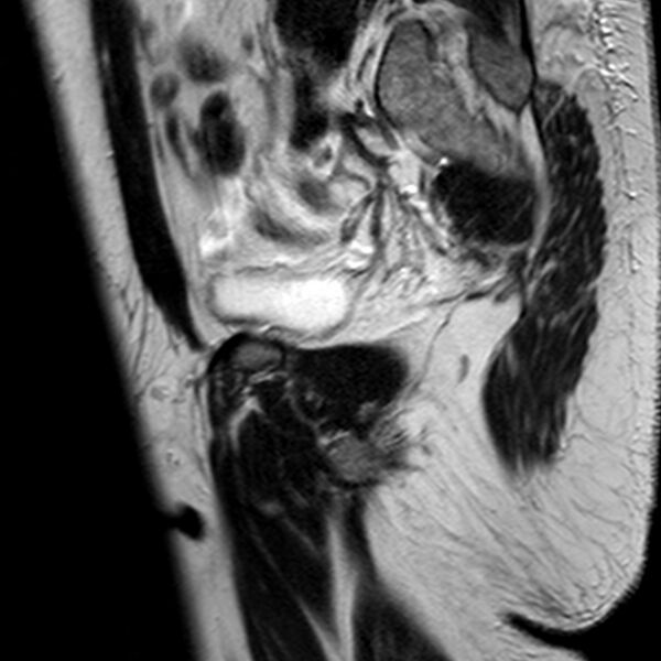 File:Adenomyoma of the uterus (Radiopaedia 9871-10439 Sagittal T2 21).jpg