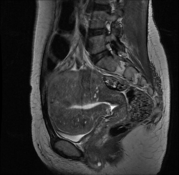 File:Adenomyosis on MRI (Radiopaedia 29328-29780 Sagittal T2 11).jpg