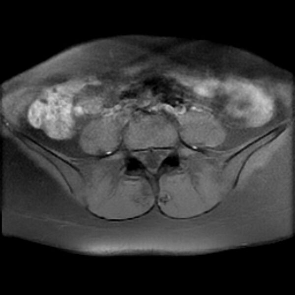 File:Adenomyosis within a septate uterus (Radiopaedia 69963-79981 Axial T1 fat sat 2).jpg