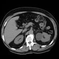 Adrenal hemangioma (Radiopaedia 11039-11445 Axial non-contrast 9).jpg