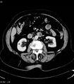 Adrenal myelolipoma (Radiopaedia 6765-7960 Axial C+ arterial phase 17).jpg