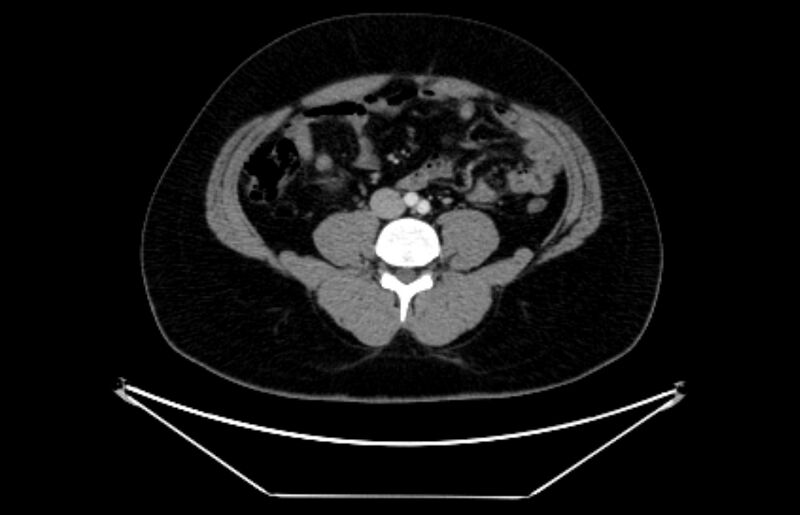 File:Adrenocortical carcinoma (Radiopaedia 80134-93438 Axial C+ portal venous phase 80).jpg