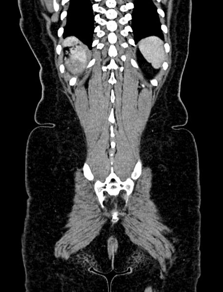 File:Adrenocortical carcinoma (Radiopaedia 87281-103569 Coronal C+ portal venous phase 136).jpg